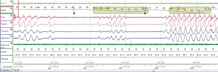 Management of central sleep apnoea: a review of non-hypercapnic causes.