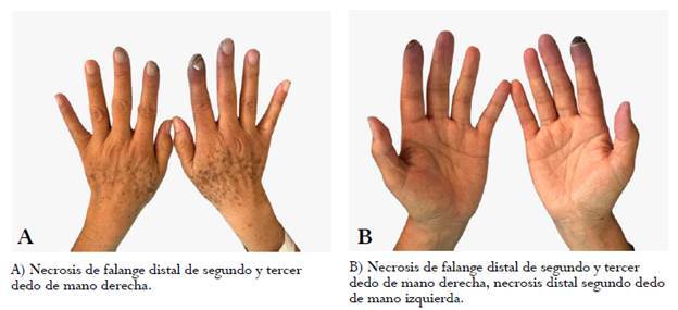 Gemcitabine-induced digital necrosis in a patient with cervical squamous cell carcinoma: case report and literature review