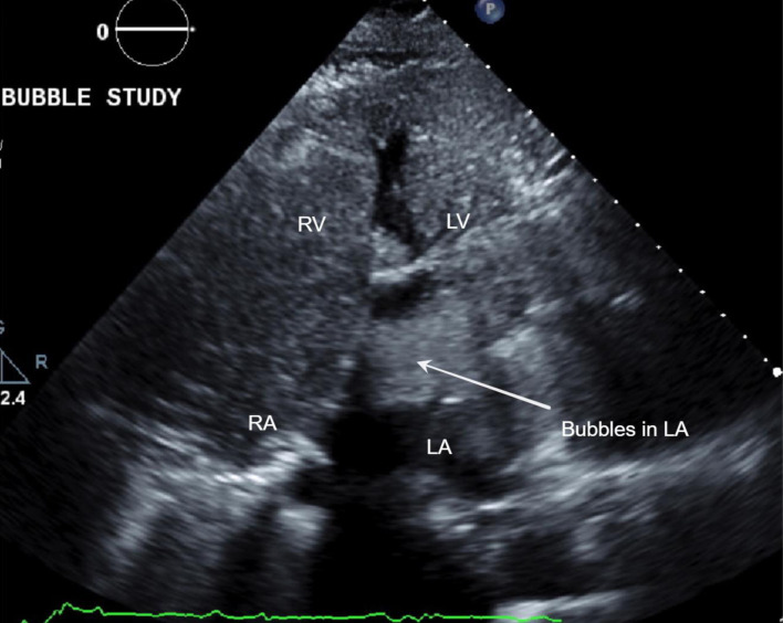 Unmasking the Rarity: A Case Report on Platypnea-Orthodeoxia Syndrome With Successful Resolution Through Patent Foramen Ovale Closure.