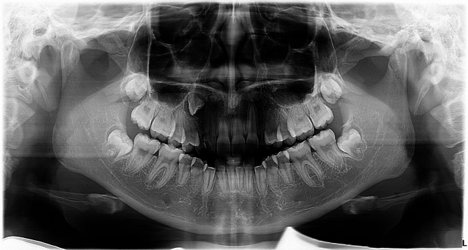 Congenitally missing permanent canines in a sample of Chinese population: a retrospective study.