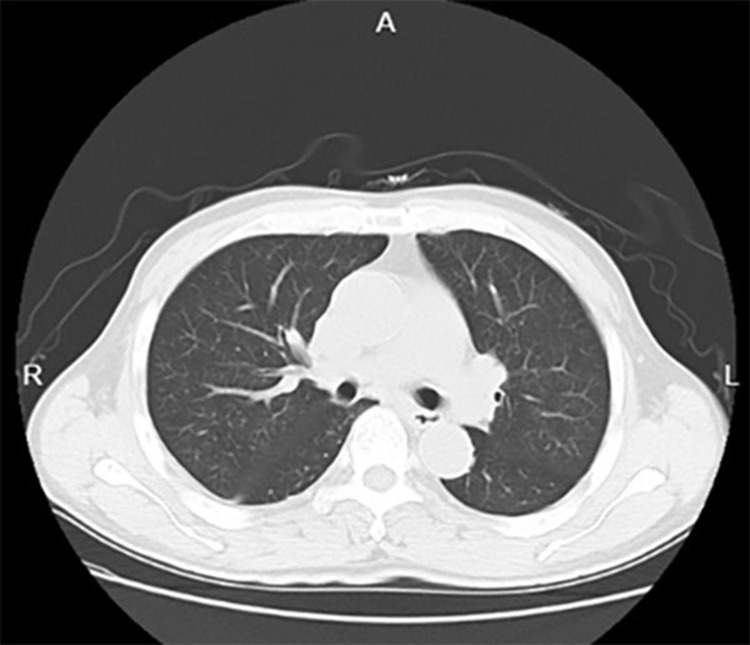 Thyroid Gland as a Metastatic Site for Hepatocellular Carcinoma: A Rare Case Report.