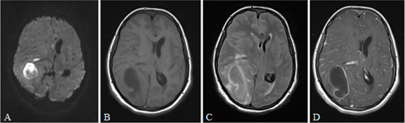 Infectious brain abscesses and granulomas: analysis of 110 episodes in adults.