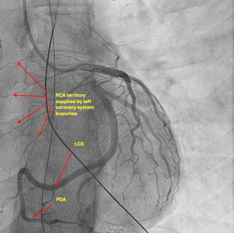 Electrical storm caused by sertraline overdose: case report.