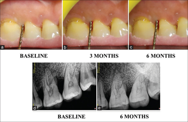 Comparative evaluation of herbal gel as an adjunct to nonsurgical periodontal therapy in Stage III periodontitis: A randomized split-mouth clinical trial.