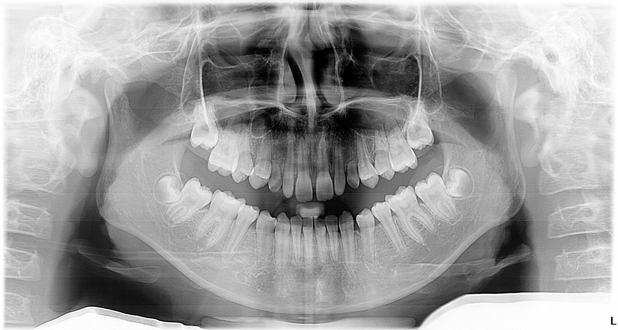 Congenitally missing permanent canines in a sample of Chinese population: a retrospective study.