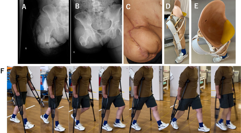 Gait Acquisition with a Quadrilateral Socket after Ultra-short Transfemoral Amputation because of Staphylococcal Toxic Shock Syndrome.