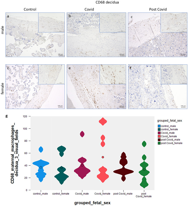 PD-L1 expression and characterization of its carrier macrophages in placentas with acute and specifically post-SARS-CoV-2 infection.