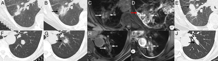 The Value of Magnetic Resonance Imaging in Assessing Immediate Efficacy After Microwave Ablation of Lung Malignancies.