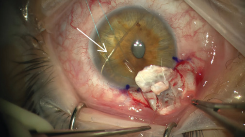 Outcomes of microcatheter-assisted trabeculotomy in adult patients with primary congenital glaucoma and juvenile open-angle glaucoma: A case series.