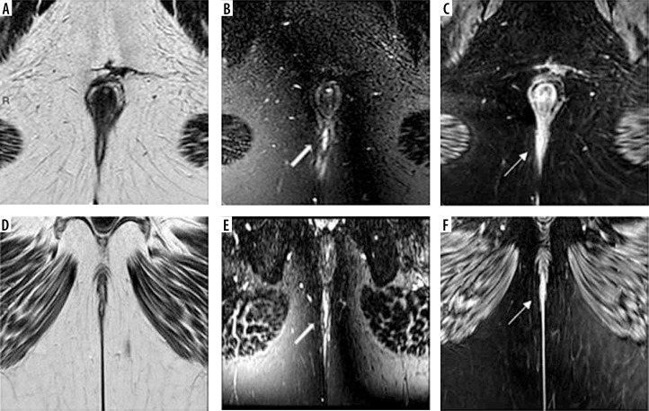 Added value of volumetric MRI pulse sequence 3D VISTA (Volume ISotopic Turbo spin echo Acquisition) in perianal fistula depiction and characterization.