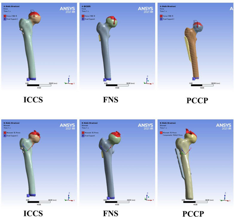 Biomechanical evaluation of percutaneous compression plate and femoral neck system in Pauwels type III femoral neck fractures.