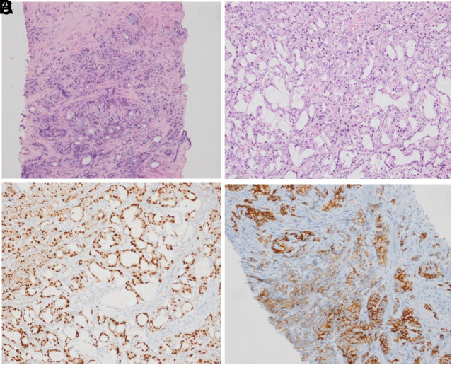 A Rare Cause of Mechanical Icterus: Prostate Cancer Metastasis.