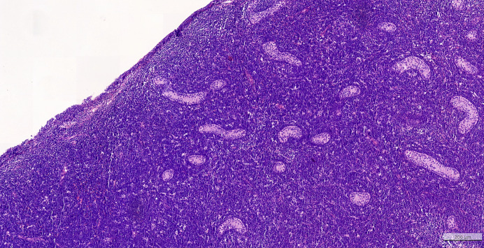 Pediatric Aleukemic Leukemia Cutis with Testicular Involvement: A Case Report.