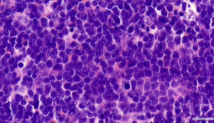 Pediatric Aleukemic Leukemia Cutis with Testicular Involvement: A Case Report.