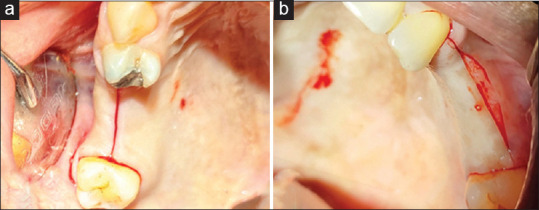 Subcrestal incision: An alternative flap design for dental implant placement - A randomized controlled split-mouth design clinical trial.