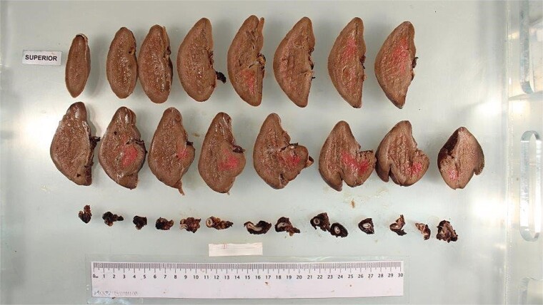 Splenic artery pseudoaneurysm rupture post-laparoscopic sleeve gastrectomy.