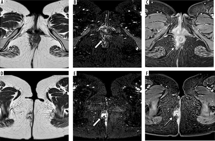 Added value of volumetric MRI pulse sequence 3D VISTA (Volume ISotopic Turbo spin echo Acquisition) in perianal fistula depiction and characterization.