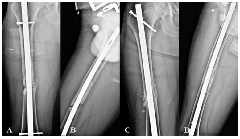 Comparative Study of Exchange Nailing and Augmentative Plating for Treating Aseptic Nonunion of Femoral Shafts Post Intramedullary Nailing: A Single-Blind, Multicentric Randomized Clinical Trial.