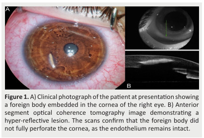Anterior Segment Optical Coherence Tomography-Assisted Surgical Planning for Removal of a Corneal Foreign Body: A Case Report and Literature Review.