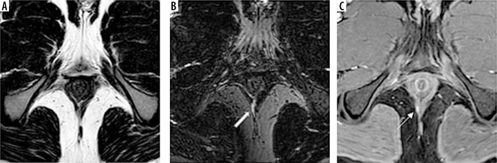 Added value of volumetric MRI pulse sequence 3D VISTA (Volume ISotopic Turbo spin echo Acquisition) in perianal fistula depiction and characterization.