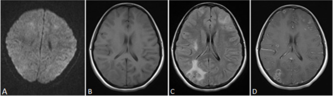 Infectious brain abscesses and granulomas: analysis of 110 episodes in adults.