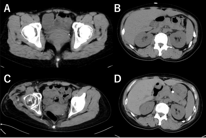 Gait Acquisition with a Quadrilateral Socket after Ultra-short Transfemoral Amputation because of Staphylococcal Toxic Shock Syndrome.