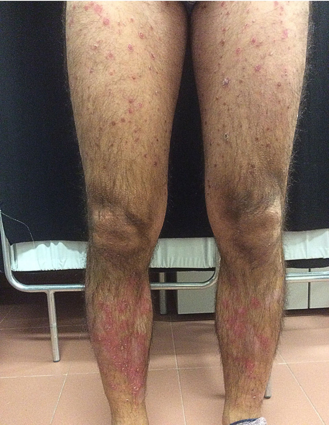 Psoriasis Flare Following Paramyxovirus Infection.