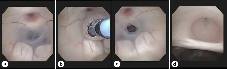 A Case of Aqueductal Stenosis with Bilateral Papilledema and Abducens Nerve Palsies without Headache.