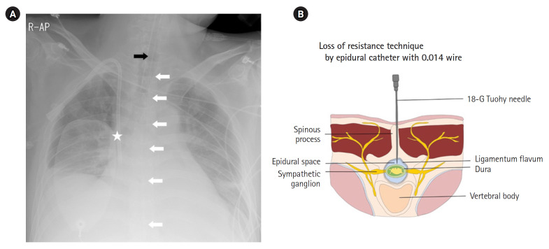 Successful neural modulation of bedside modified thoracic epidural anesthesia for ventricular tachycardia electrical storm.