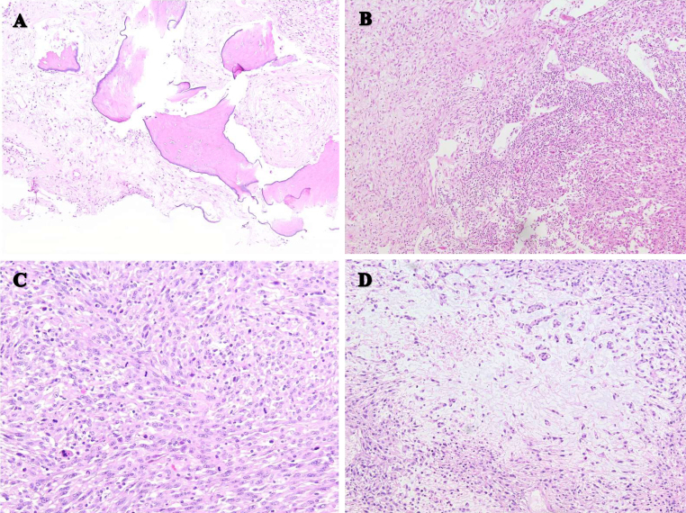Malignant sarcomatous transformation of calvarial fibrous dysplasia: illustrative case.
