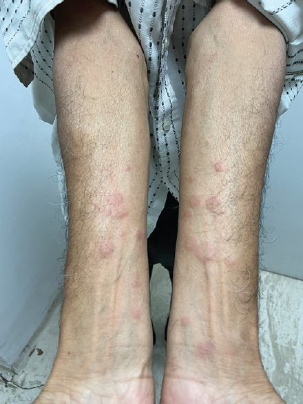 Mirabegron-induced acute urticaria: An uncommon cutaneous adverse drug reaction.