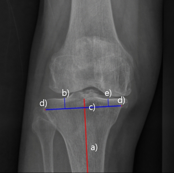 A deep learning based automatic two-dimensional digital templating model for total knee arthroplasty.