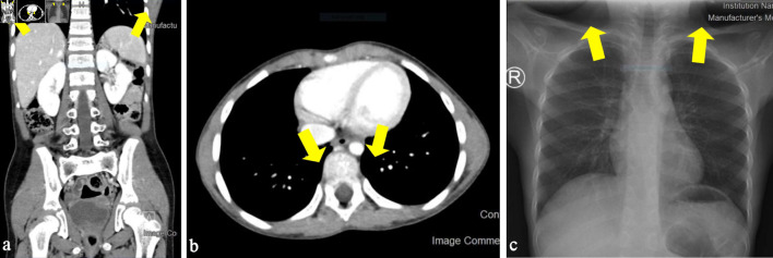 Tonsillar Diffuse Large B-Cell Lymphoma of Non-Germinal Center Type With Cluster of Differentiation 5 Positive in a Pediatric Girl.