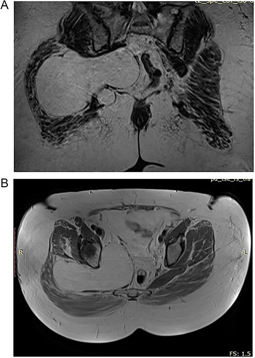 Transgluteal approach for excision of pelvic lipoma causing sciatic pain.