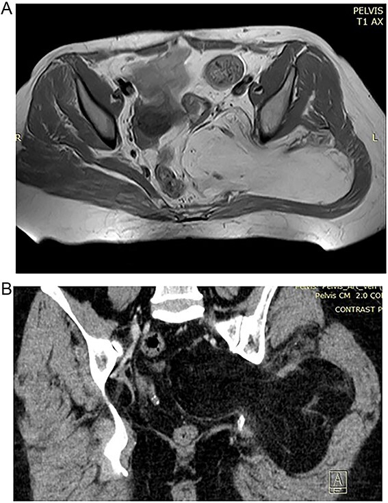 Transgluteal approach for excision of pelvic lipoma causing sciatic pain.
