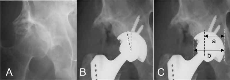 Effects of prior shelf procedure on subsequent conversion total hip arthroplasty.
