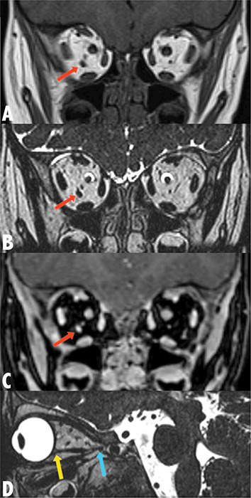 Accessory Extraocular Muscle: A Rare Cause of Strabismus.