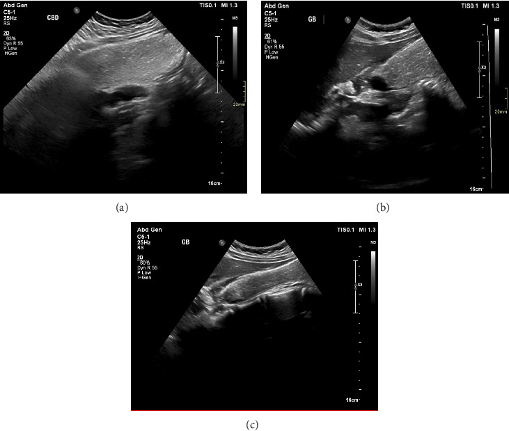 Neurofibromatosis Type 2 Presenting as Symptomatic Gallbladder Hydrops: A Rare Case Report and Literature Review.