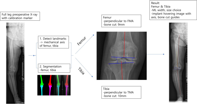 A deep learning based automatic two-dimensional digital templating model for total knee arthroplasty.