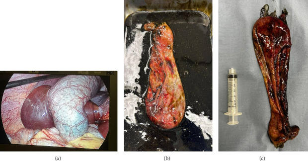 Neurofibromatosis Type 2 Presenting as Symptomatic Gallbladder Hydrops: A Rare Case Report and Literature Review.