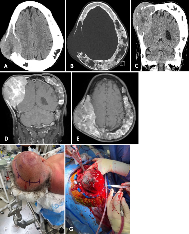 Malignant sarcomatous transformation of calvarial fibrous dysplasia: illustrative case.