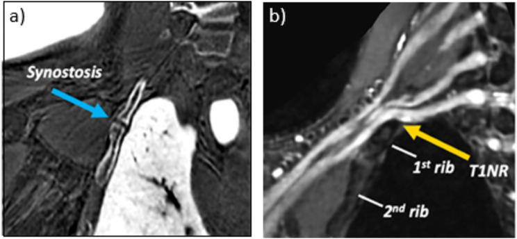 3D printing of the brachial plexus and its osseous landmarks using magnetic resonance neurography for thoracic outlet syndrome evaluation.