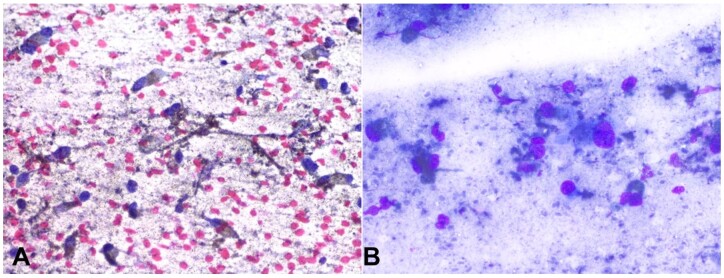 Mucosal melanoma of hard palate.