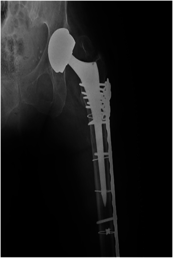 Use of 1 mm Cerclage Cables in Surgical Treatment of Periprosthetic Femur Fractures.