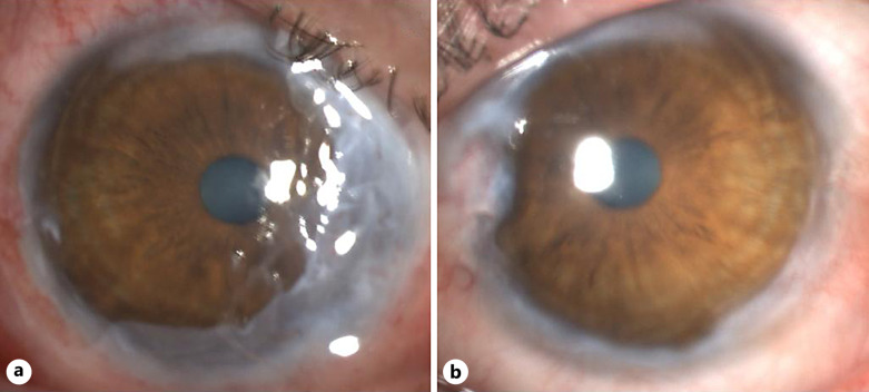 Human Amniotic Membrane Graft in the Management of Peripheral Hypertrophic Subepithelial Corneal Degeneration: A Case Report.