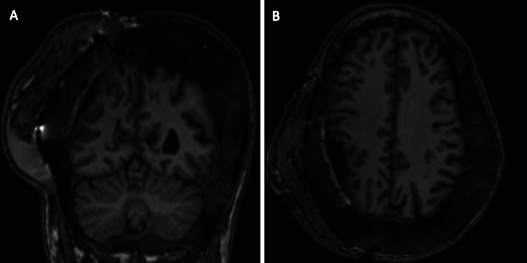 Malignant sarcomatous transformation of calvarial fibrous dysplasia: illustrative case.