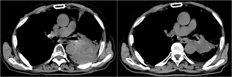 Feasibility and Tolerability of Anlotinib Plus PD-1 Inhibitors for Previously-Treated Advanced Non-Small Cell Lung Cancer: A Retrospective Exploratory Study.