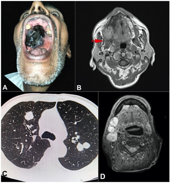 Mucosal melanoma of hard palate.