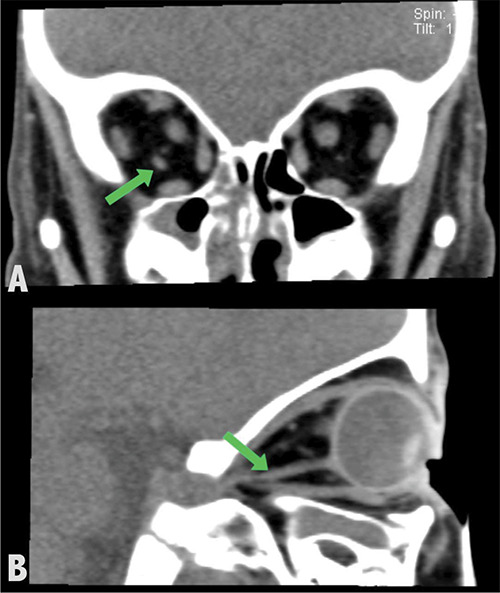 Accessory Extraocular Muscle: A Rare Cause of Strabismus.