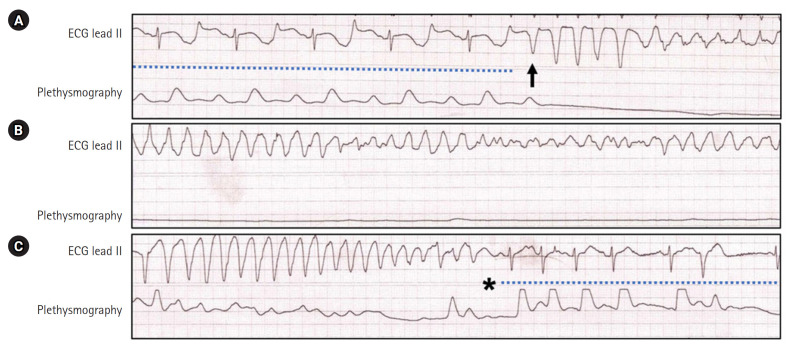 Successful neural modulation of bedside modified thoracic epidural anesthesia for ventricular tachycardia electrical storm.